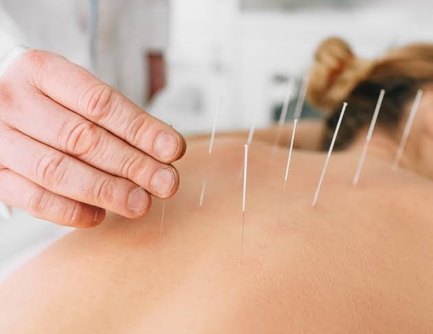 Acupuncture Therapy